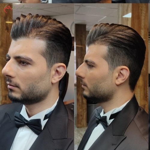 اصلاح کامل سر و صورت داماد، برداشت جوش ها، کراتینه موقت ،فیکساتور گریم صورت